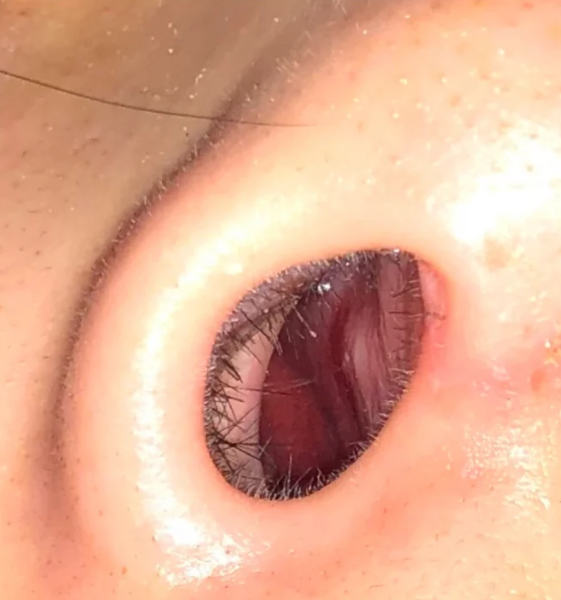 天气干燥或者上火都可能导致鼻腔黏膜充血,让鼻子谋谮