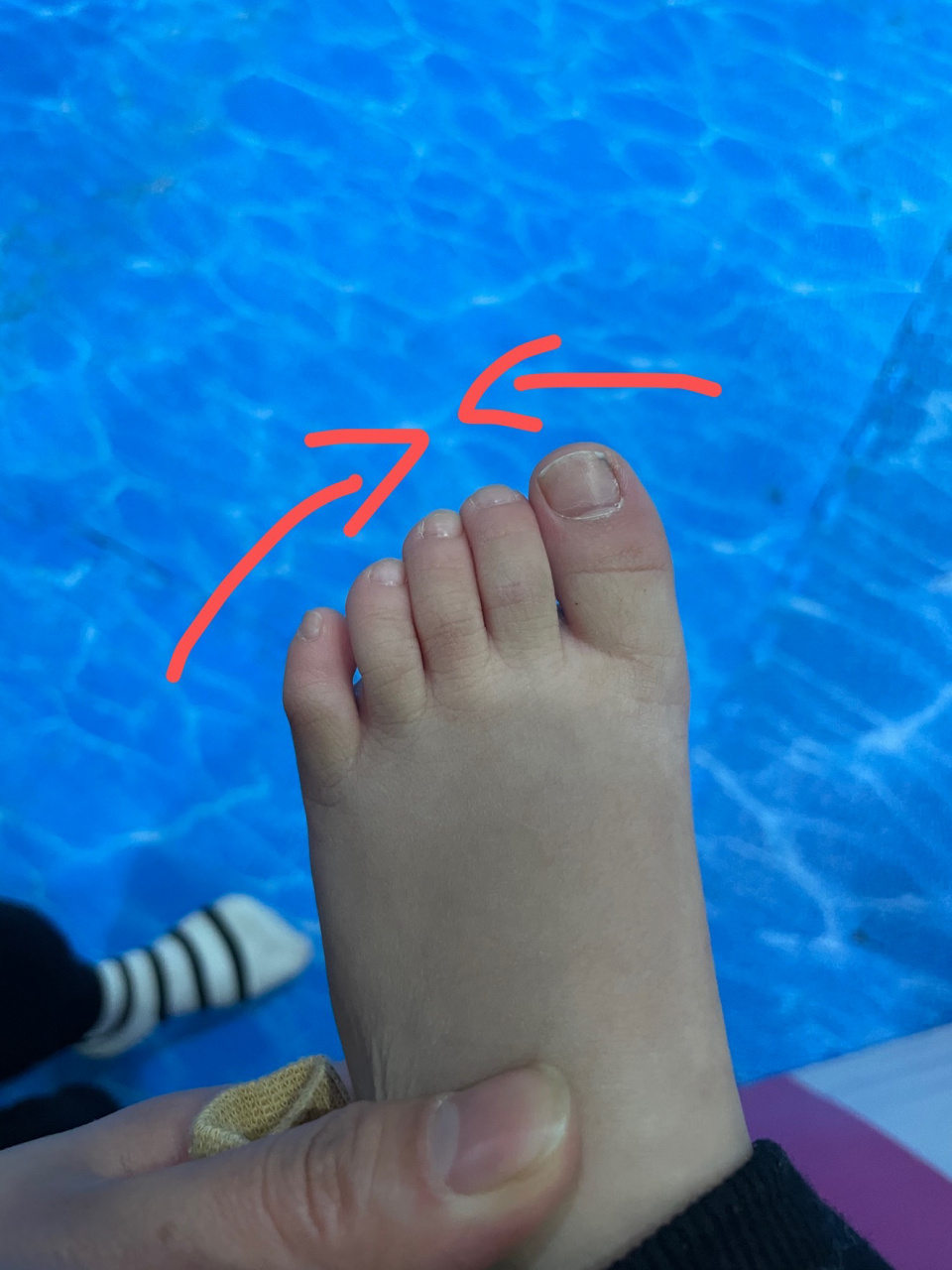 宝宝9299脚指歪了 突然发现我家宝宝大脚趾往里歪了有没有专业