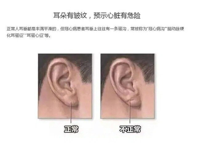 到了40岁年龄,看看自己有没有"耳褶心征" 如果你年龄已经过了四十岁