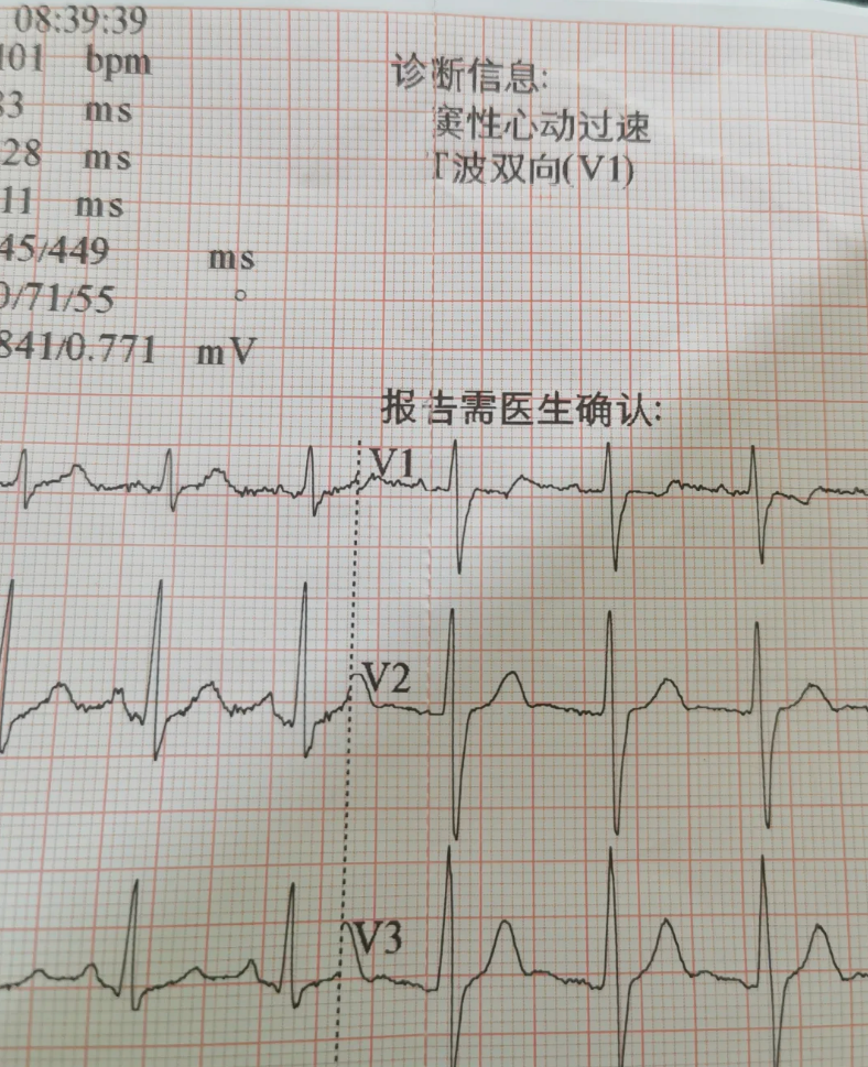 心率90多次/分是否正常要看具体情况
