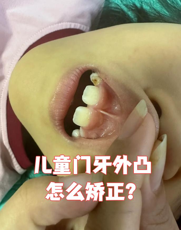 儿童门牙外凸怎么矫正?