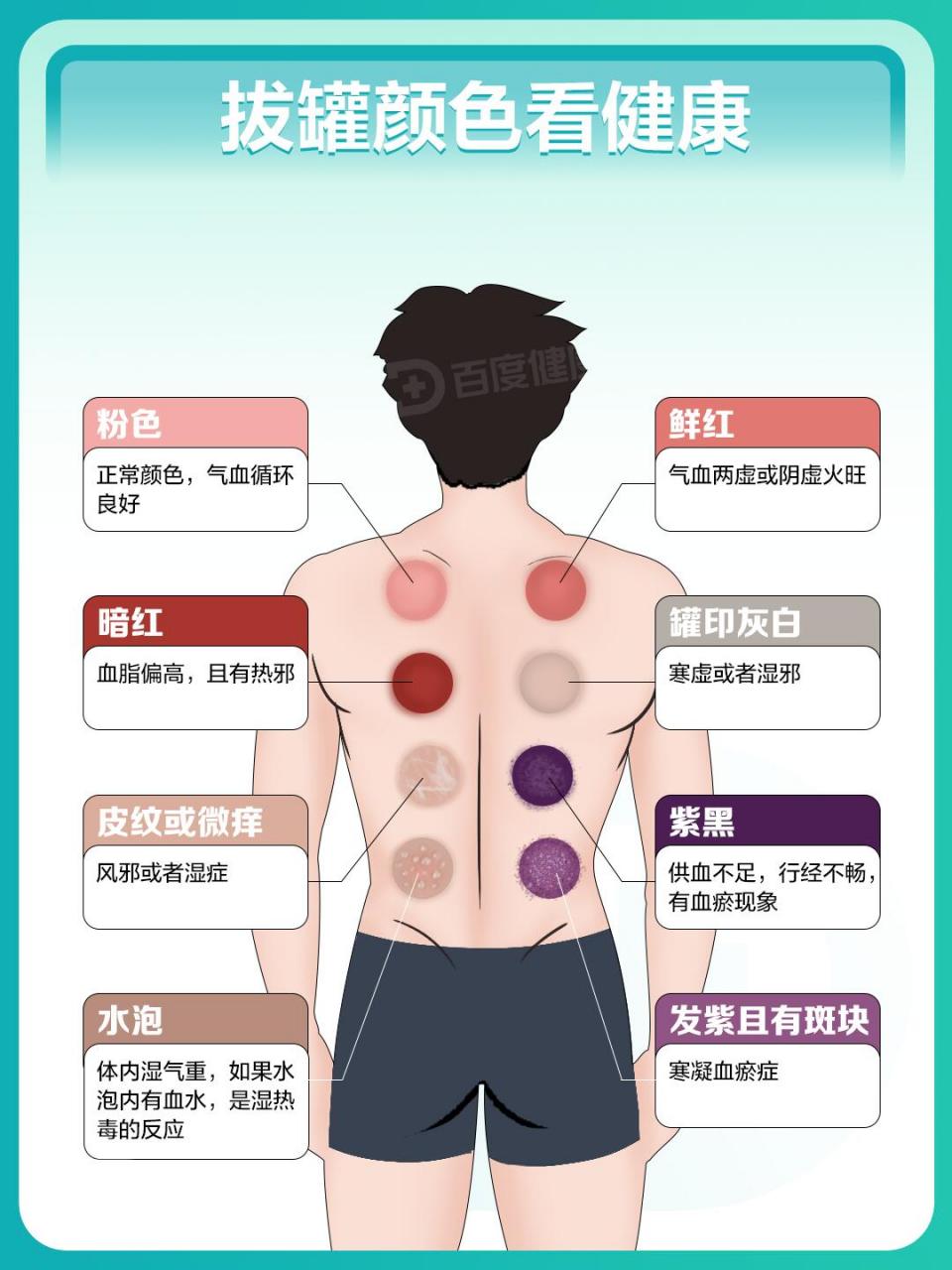 三伏天拔罐,颜色越深"毒"越多?
