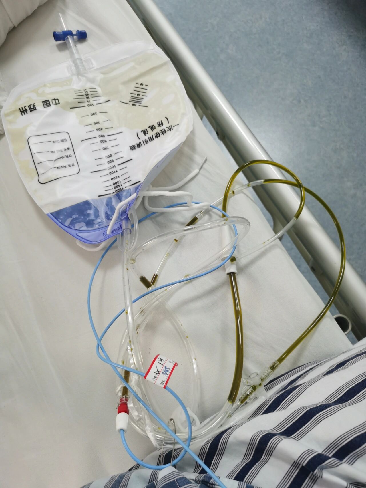 胆汁(ercp)手术胆汁外引流后有什么影响怎么拔鼻胆管结石手术第三天