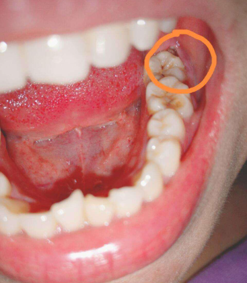 大牙最里面长了一颗牙,最常见的原因是智齿或多生牙