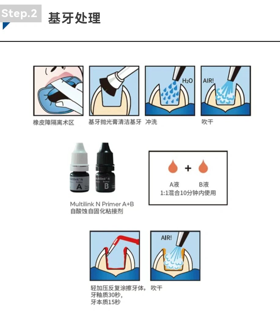 嵌体粘接步骤图图片