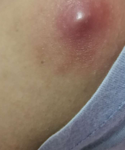 常见原因有久坐,卫生不好,毛囊炎,皮脂腺囊肿或糖尿病等