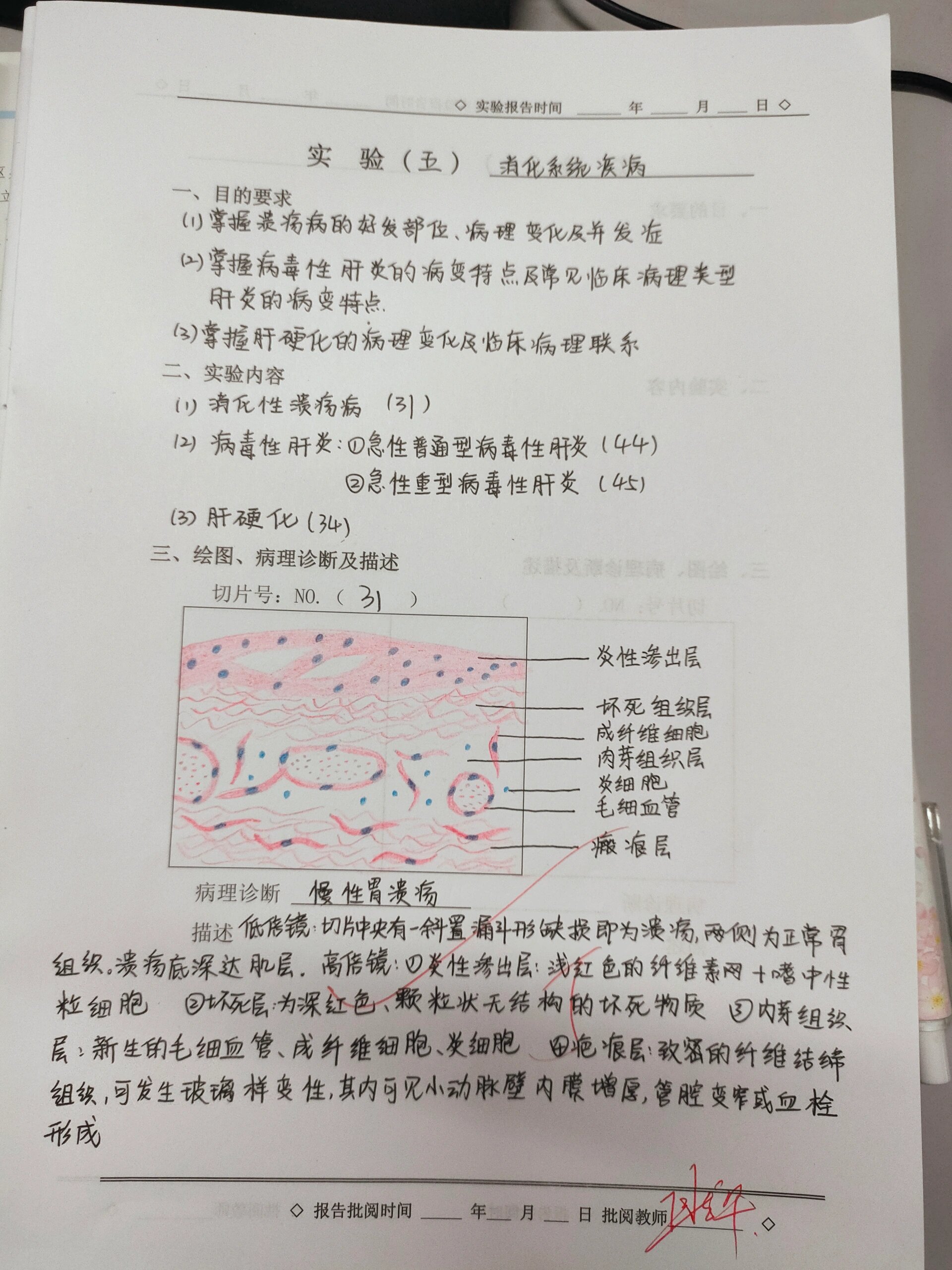 病理学实验 慢性胃溃疡红蓝铅笔绘图 消化系统疾病