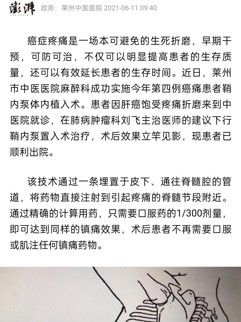 鞘内镇痛汞 妈妈最近的情况不太好,没怎么拍照片,也没怎么吃中药,吃得