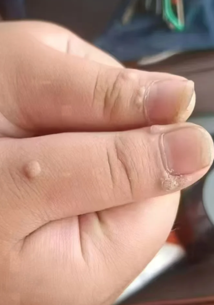 手上出现白色硬的小圆点,可能是皮下囊肿,寻常疣或甲周疣