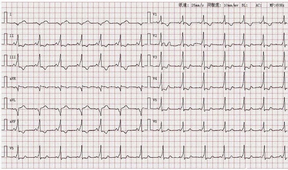 心电图图库丨心室预激系列