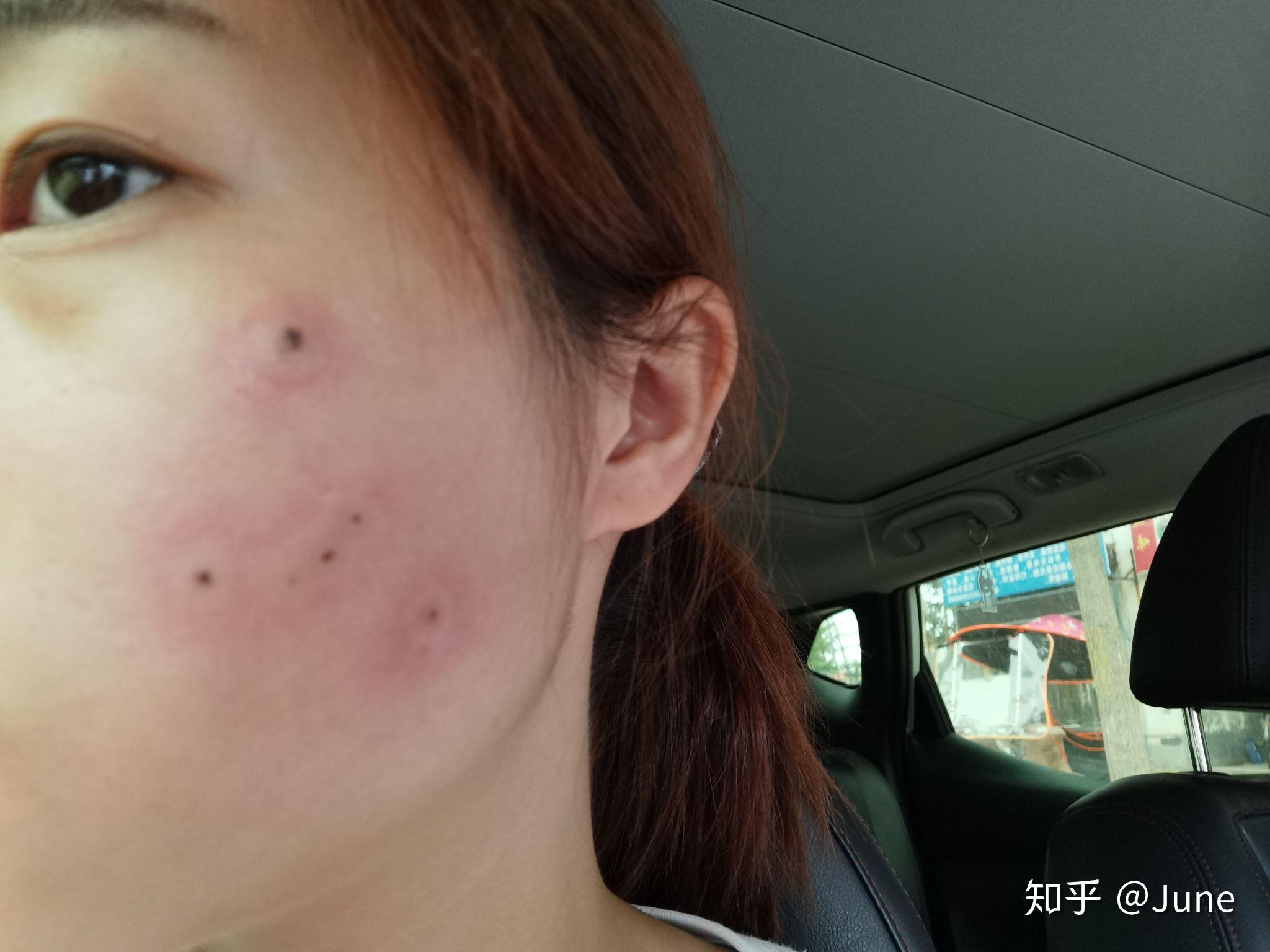 液氮冷冻点痣记录两年了