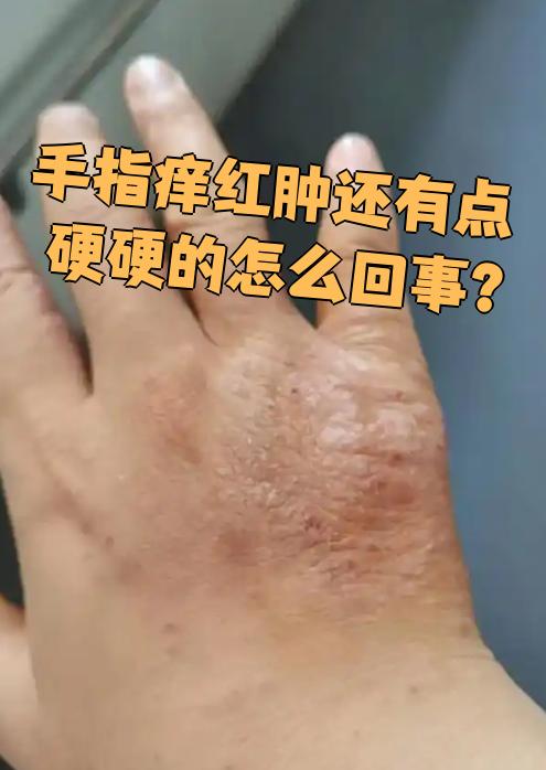 手指痒,红肿还有点硬,这种情况很可能是急性湿疹引起的