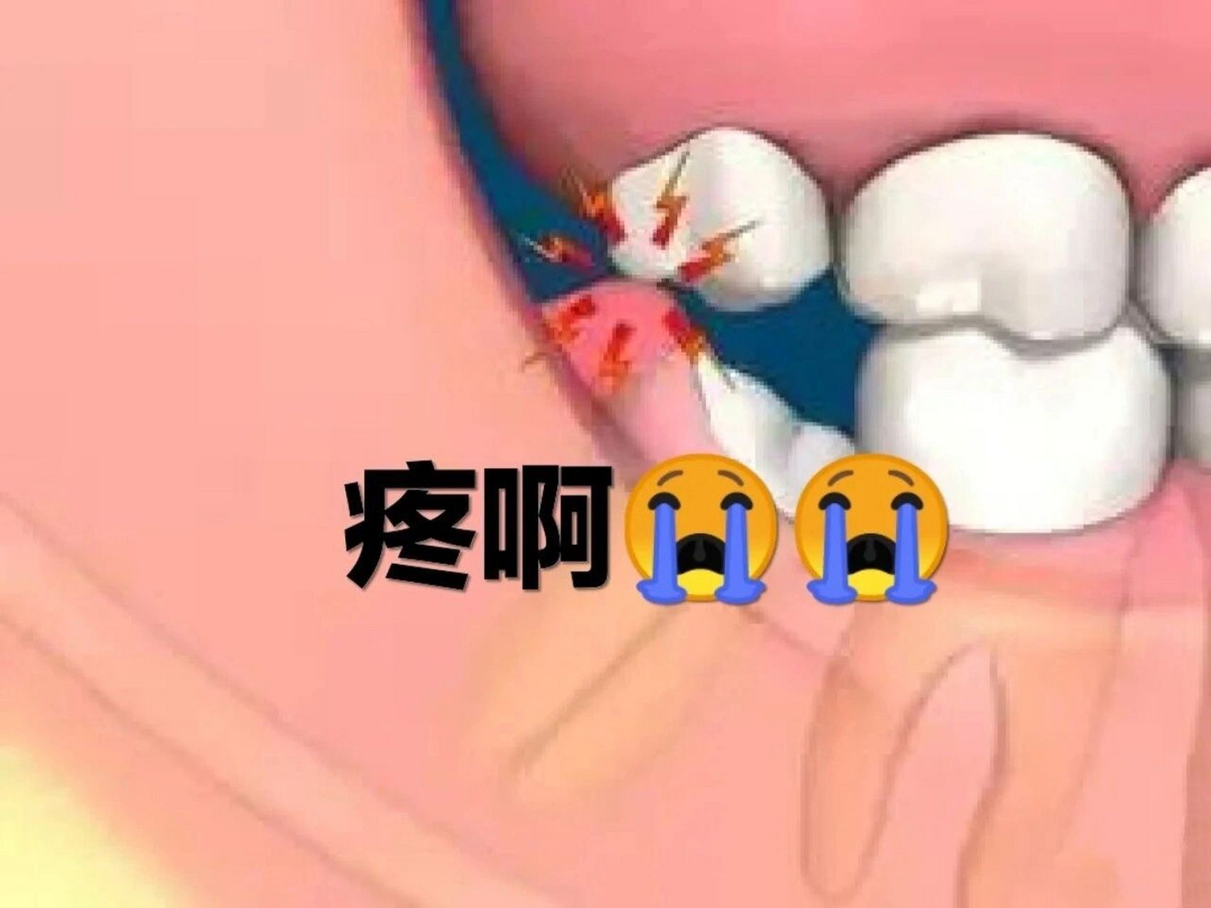 今天小和医生就跟大家聊聊智齿冠周炎是怎么回事