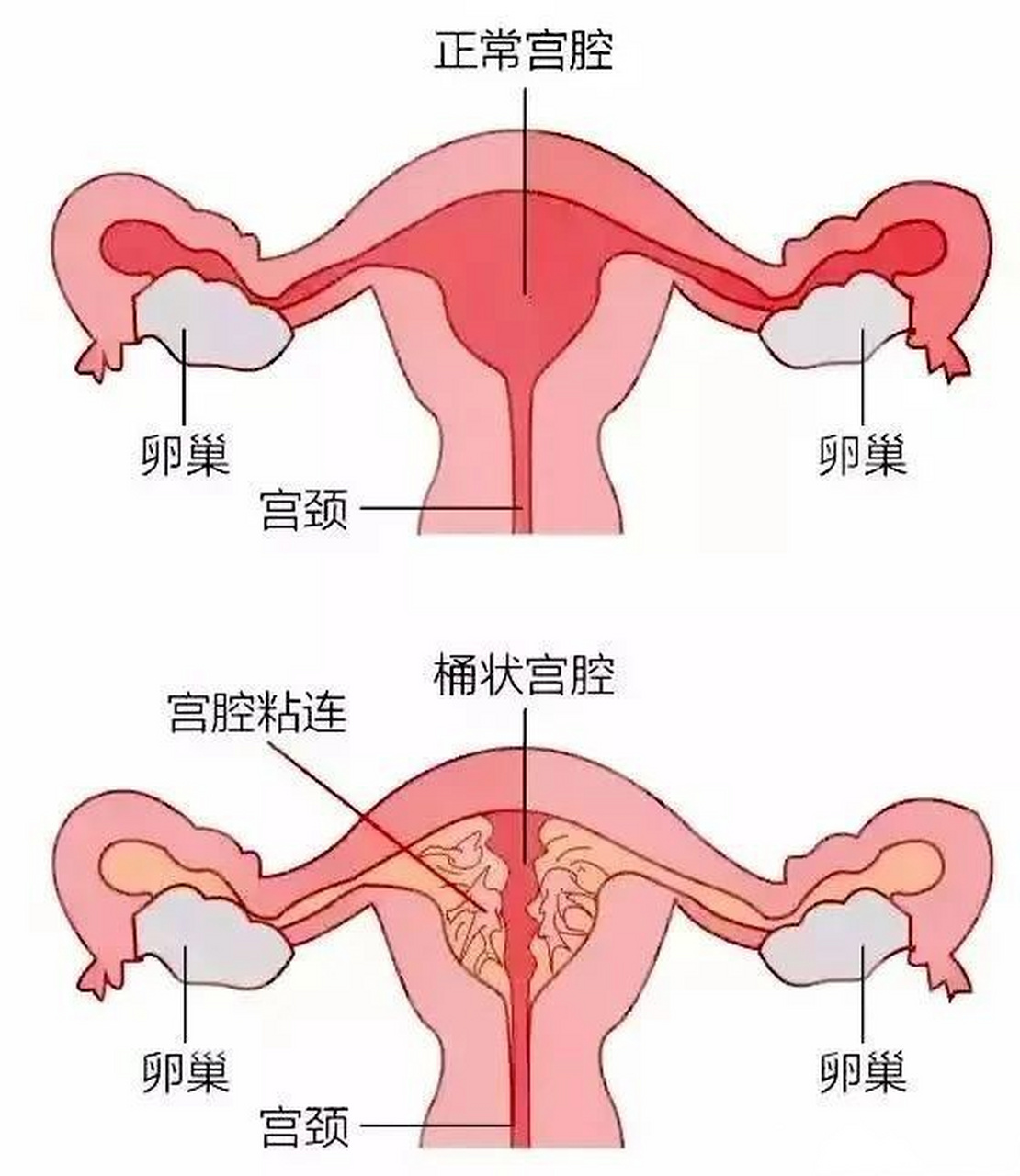 流产示意图片图片