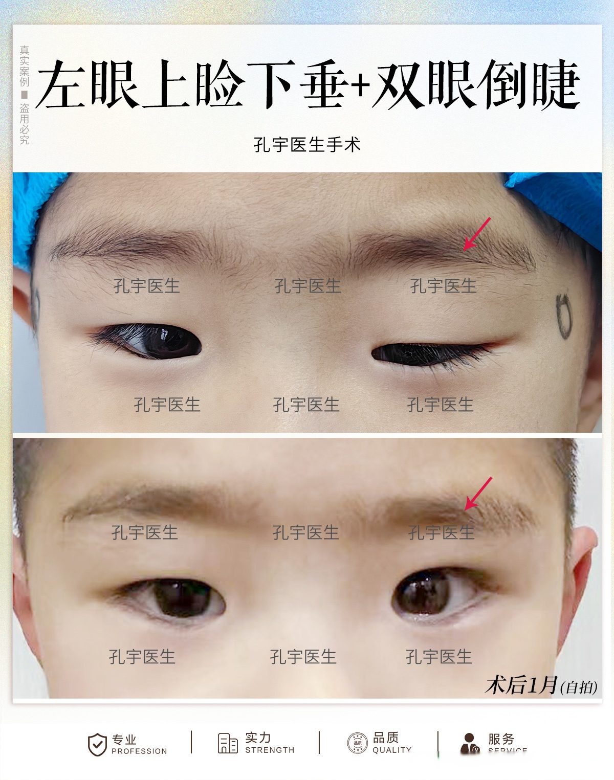 孔宇医生指出如果儿童发现上睑下垂,一定要引起重视