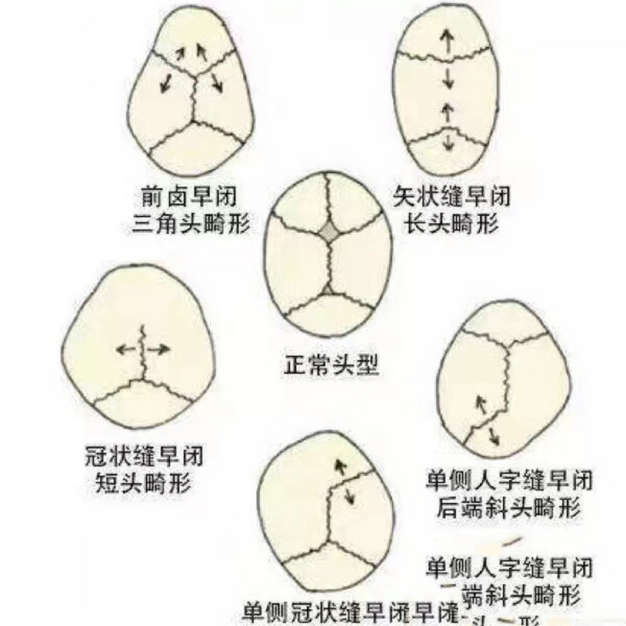 颅缝早闭矢状缝的判断及头型类型 宝妈们问我舟状头,矢状缝早闭的最多