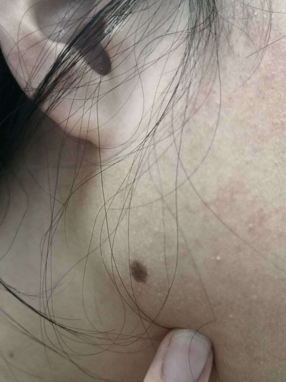 解决皮肤问题专注皮肤美容##色素痣##你好同学