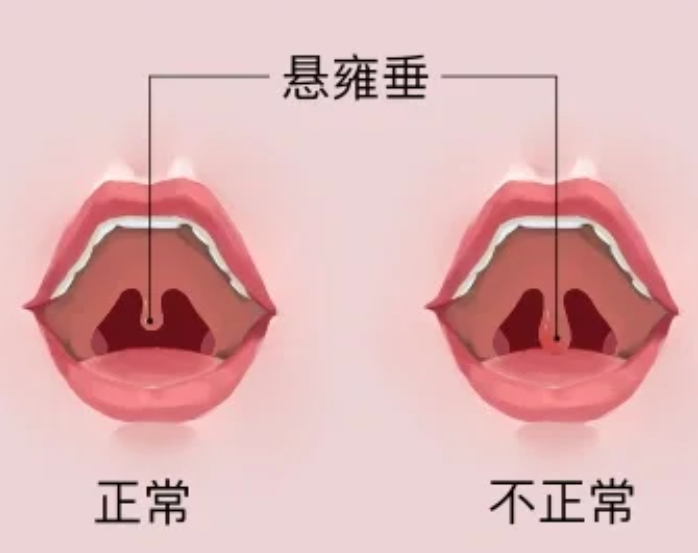 悬雍垂上长了息肉通常不会自己好,得去医院检查治疗才能慢慢恢复