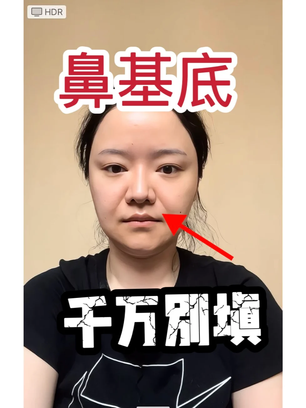 各个材料填充鼻基底优劣势对比!