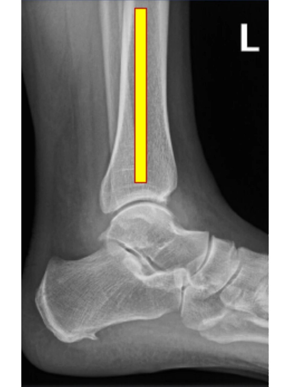 如何拍出标准的踝关节正侧位 我们先看一张较为标准的踝关节正文,看