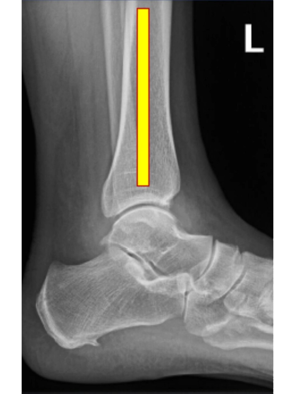 脚踝x光片 正常人图片