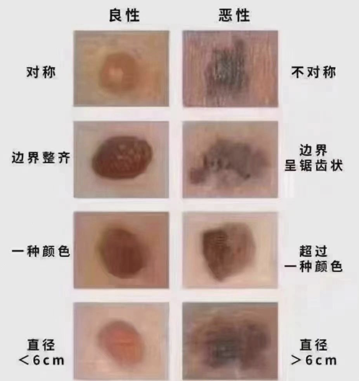 痣上长毛大部分是正常现象,但也可能是恶性病变的信号