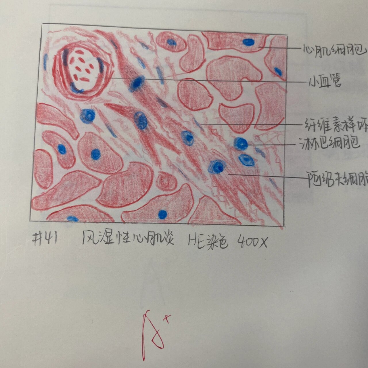 病理绘图2|持续更新 p1风湿性心肌炎 p2动脉粥样硬化 p3大叶性肺炎 p4
