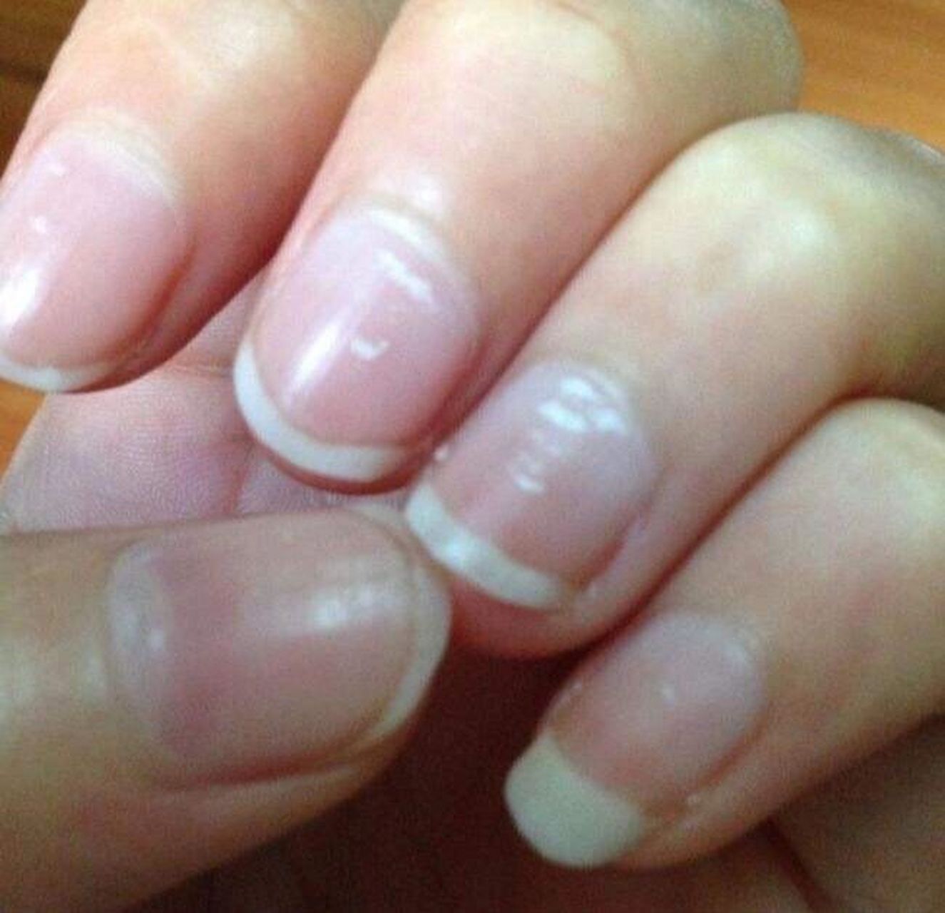 孩子指甲有白点 99如果是云雾状白点,一团一团的,这样的孩子不仅