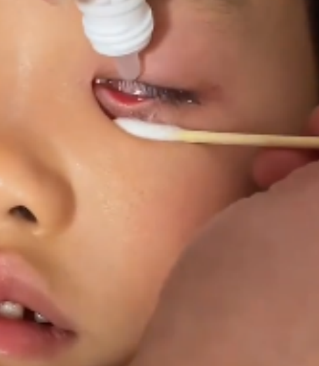 宝宝眼睛出现红血块,最常见的原因是结膜下出血或急性卡他性结膜炎