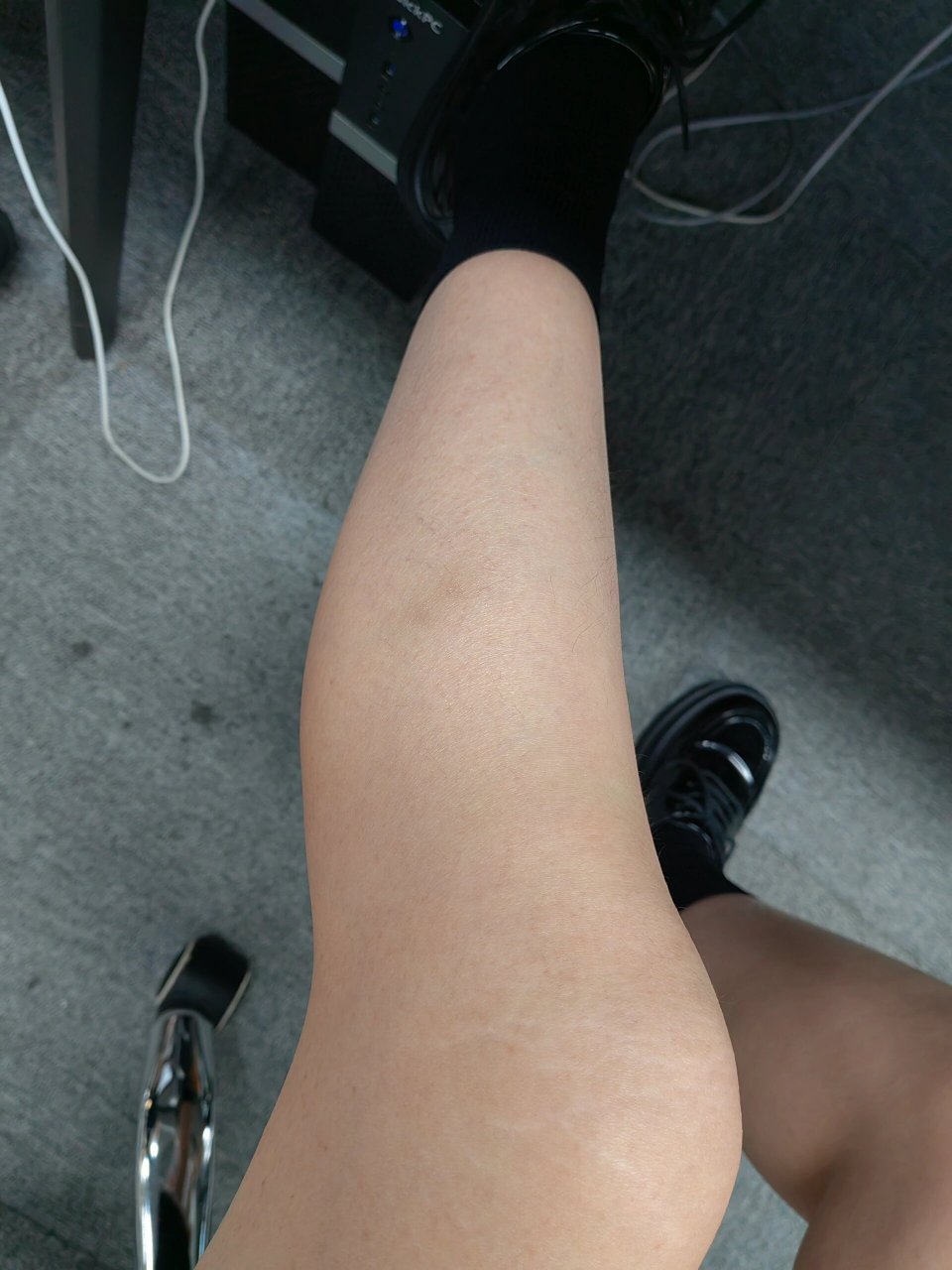 小腿上有坨淤青消不掉是怎么回事?