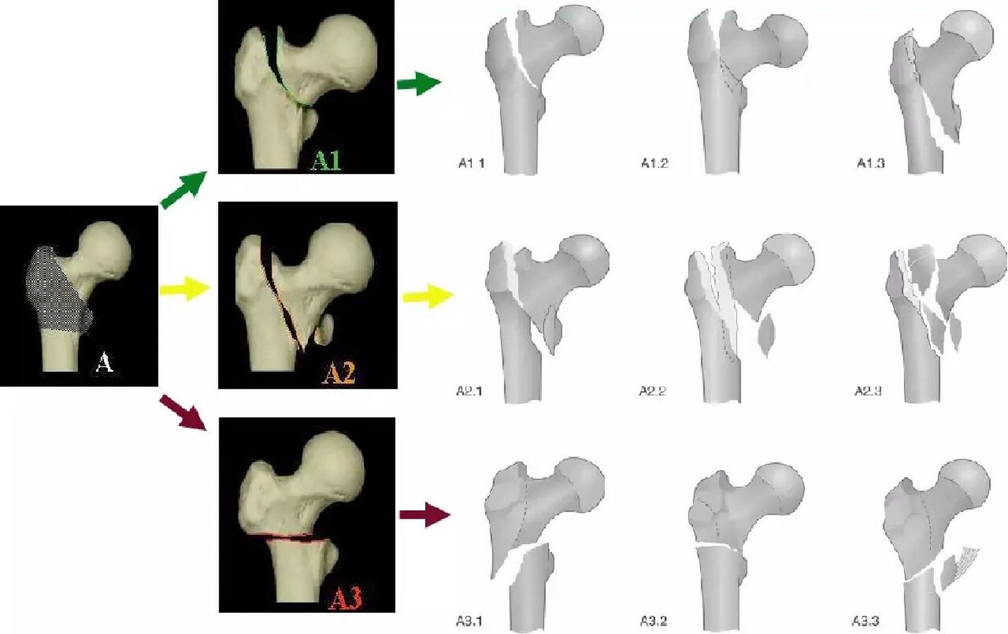 股骨骨折分型图解图片
