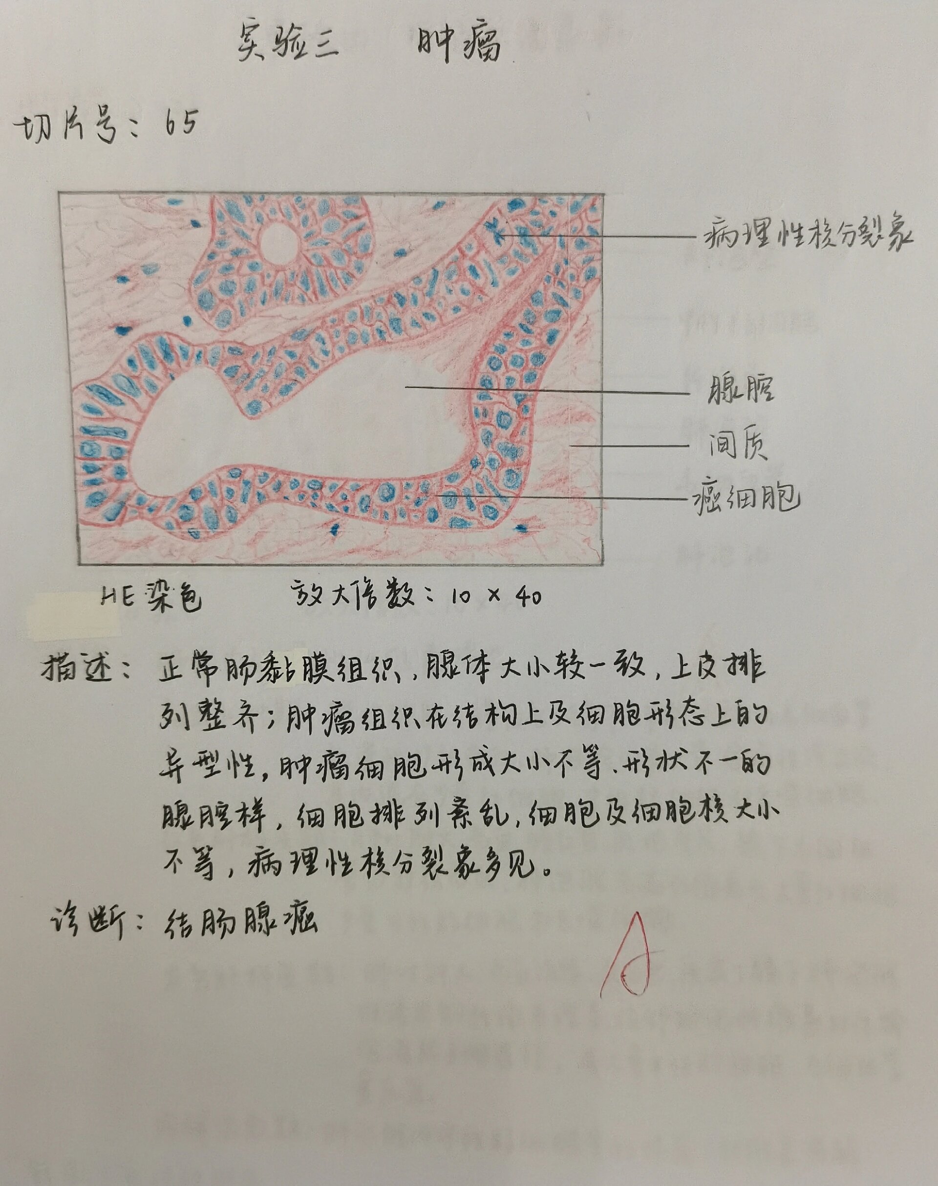 鼻息肉实验报告手绘图图片