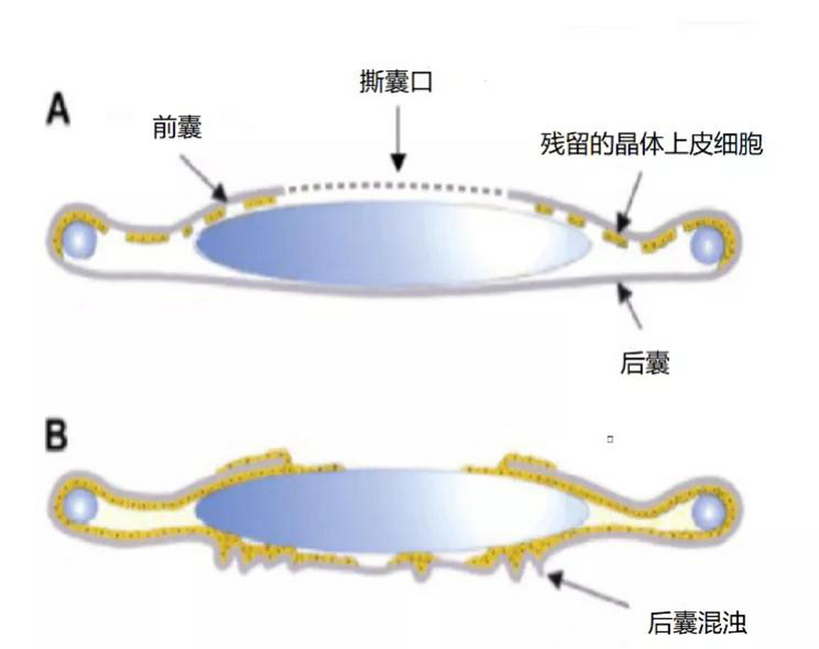 什么是后发障?白内障术后看不清怎么办? 什么是后发障?