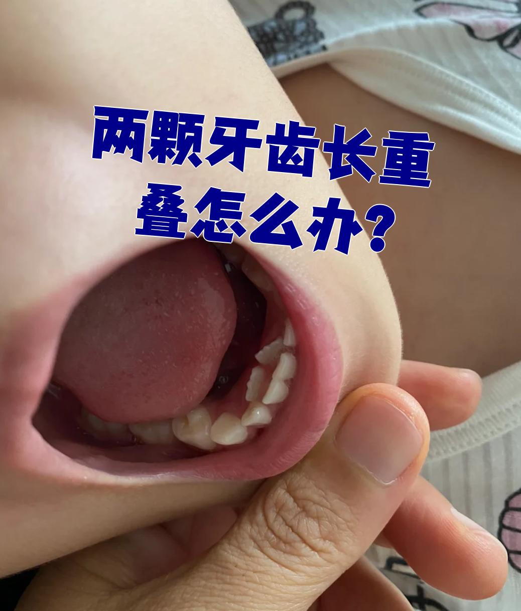 两颗牙齿长重叠了,这可能是乳牙滞留,多生牙或者牙齿畸形造成的