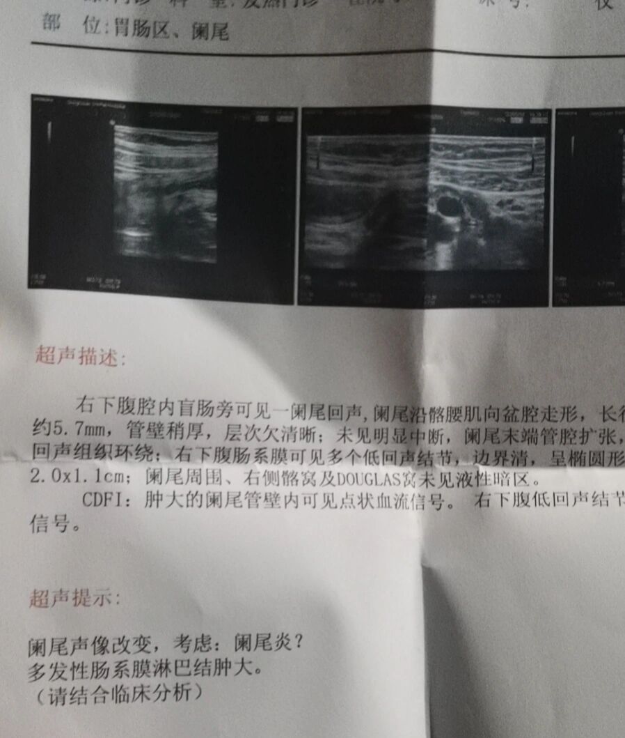 阑尾炎一定要动手术吗?