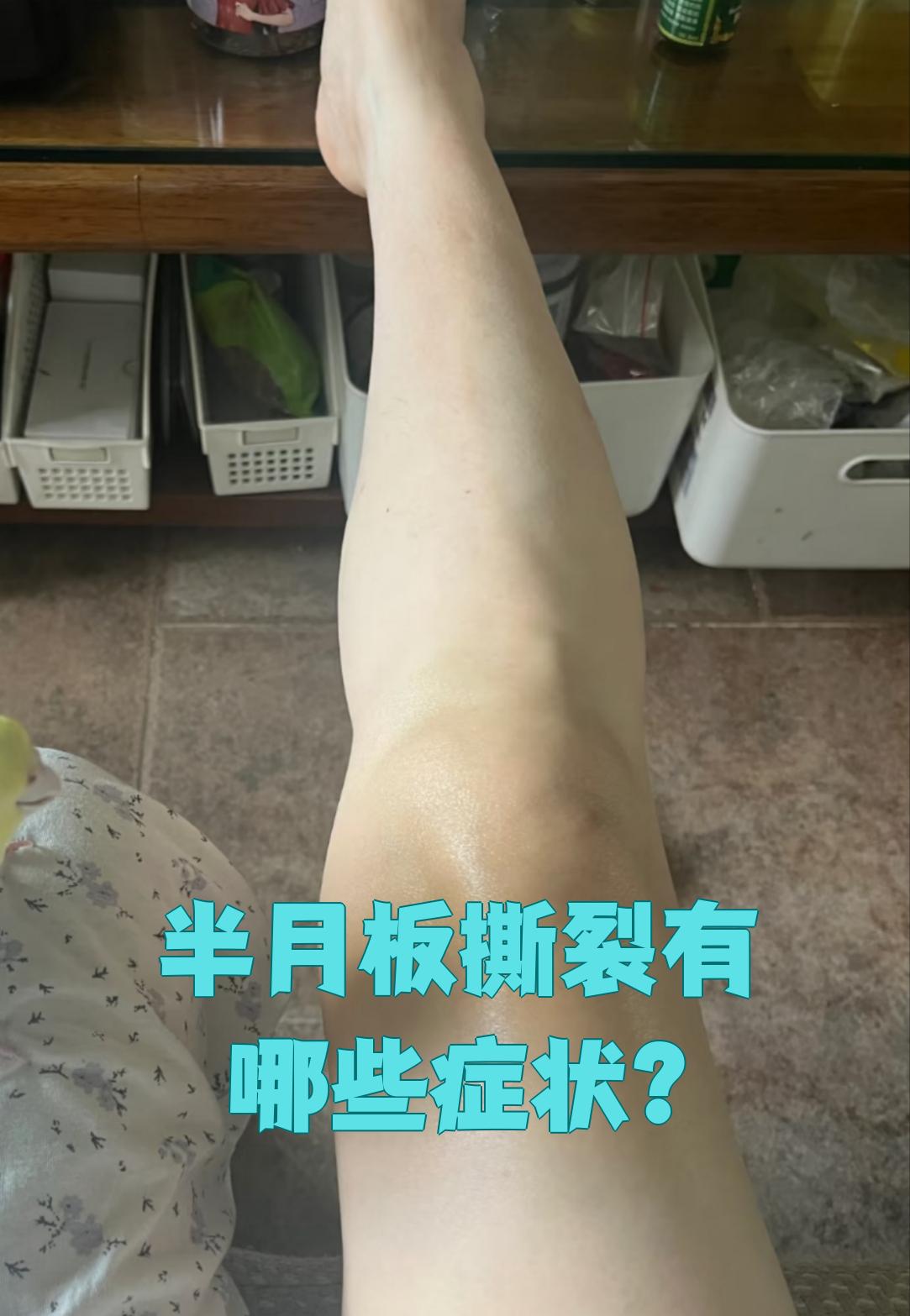 半月板撕裂最常见的症状是膝关节疼痛,关节肿胀,关节积液和活动受限