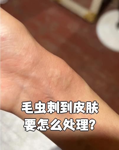 轻度处理  如果被刺毛虫蜇了,马上用胶带反