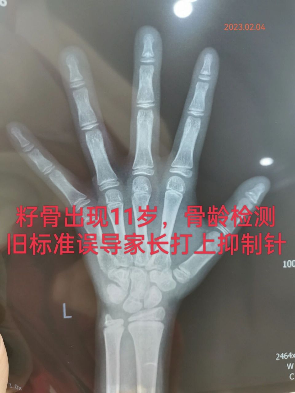 籽骨出现11岁,骨龄检测旧标准用上抑制针 性别:女 出生日期:2013年6月