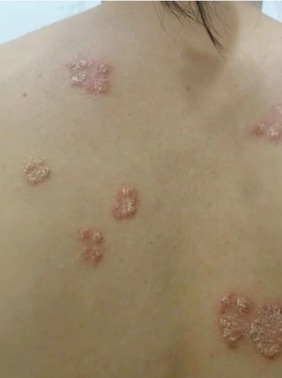 阴茎脱皮常见原因包括干性湿疹,银屑病和龟头炎