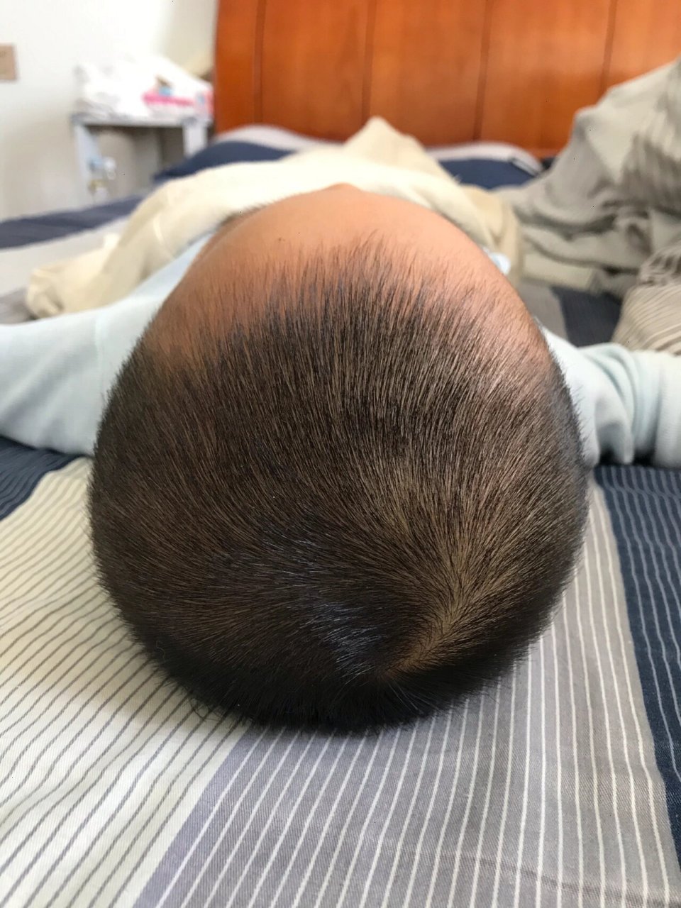 网上说一岁半内都可以矫正头型 求助,我家宝宝属于扁头严重型吗?