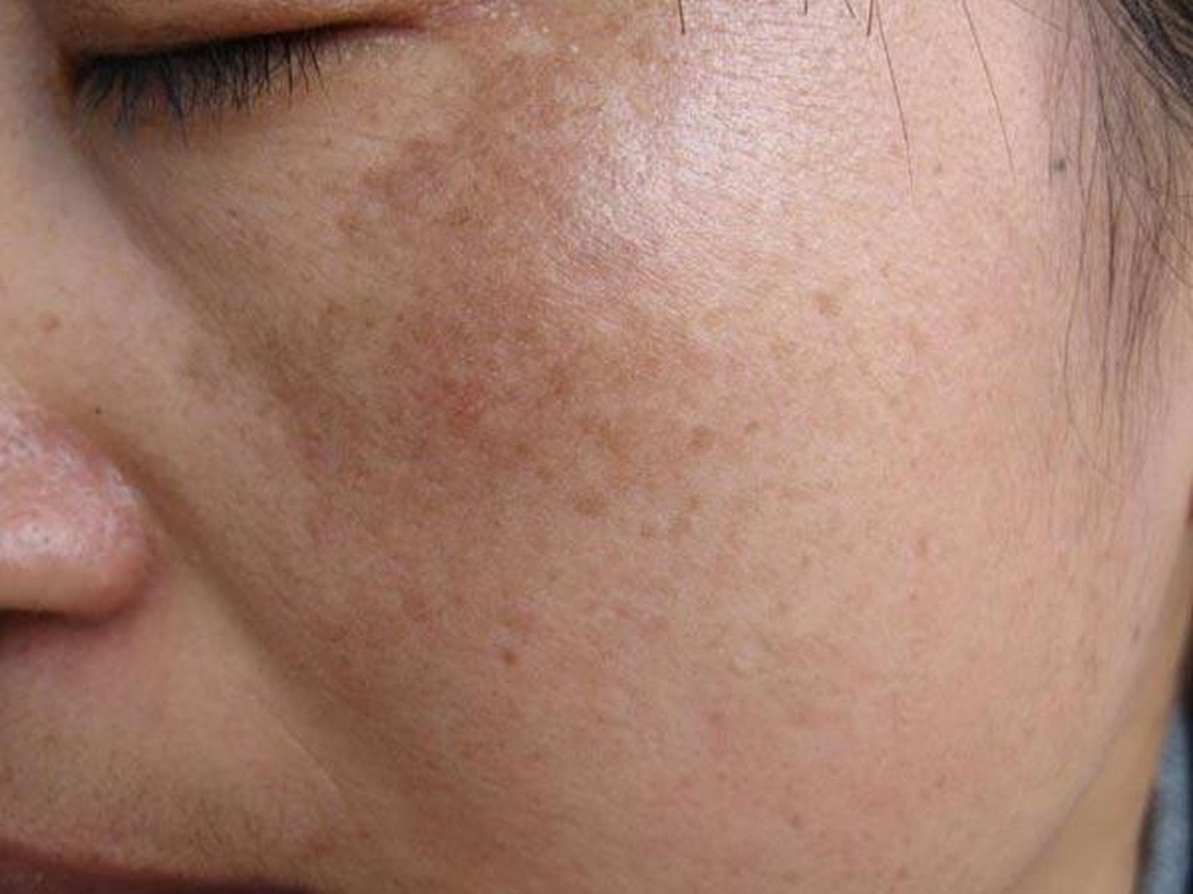 当黄褐斑刚开始出现在颧骨两侧时,是淡化黄褐斑最佳时期.