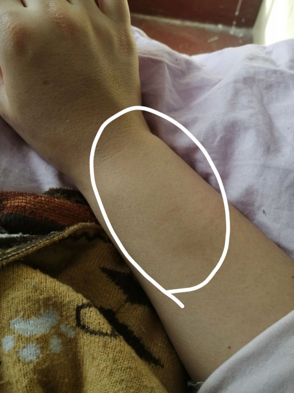 两只手臂上都这样鼓起来了是啥毛病呀