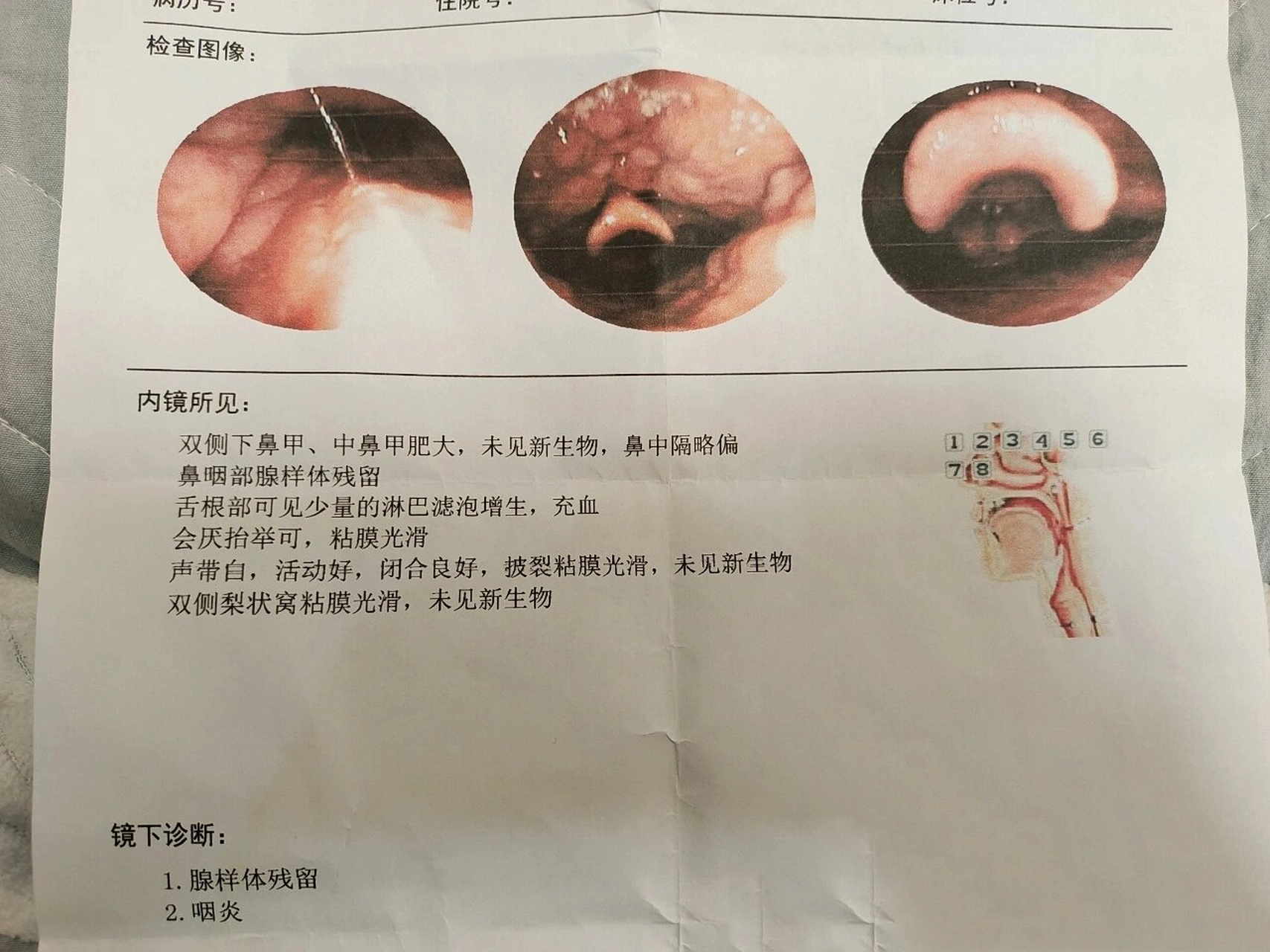 鼻咽肿物,害怕 小县城医院,怕医生误诊,有人能帮忙看看是不是腺样体