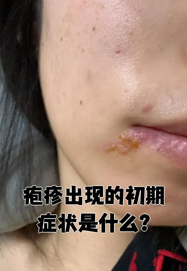 疱疹出现的初期症状是什么?