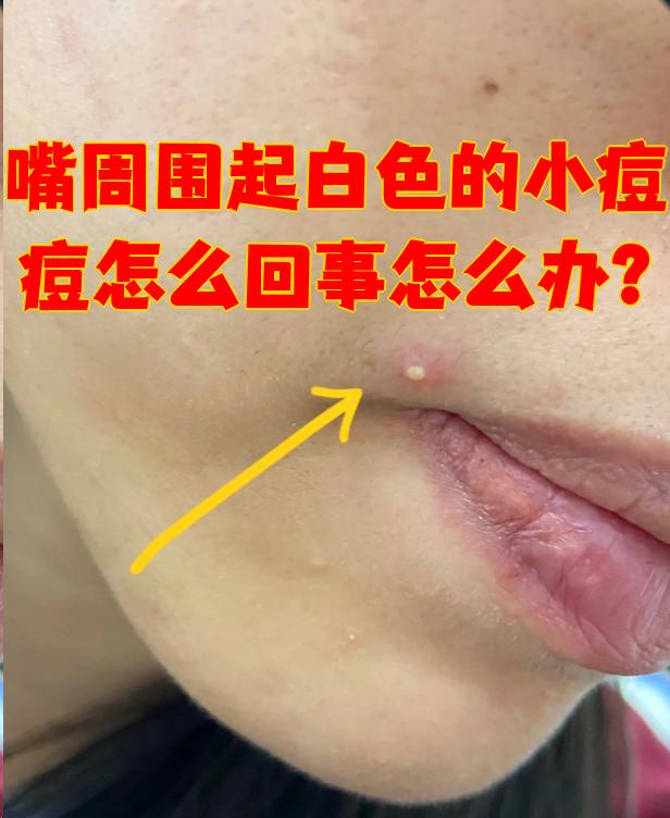 嘴周围起白色的小痘痘怎么回事怎么办?