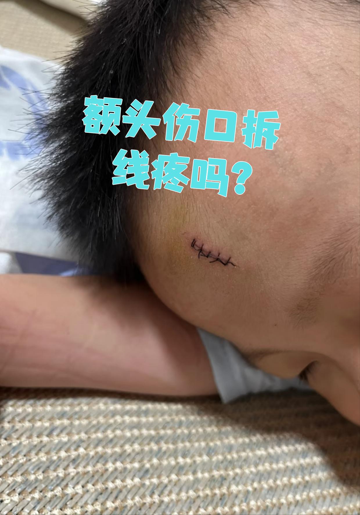 额头上的伤口一般是外伤或者手术后留下的,这两种情况拆线时都会有