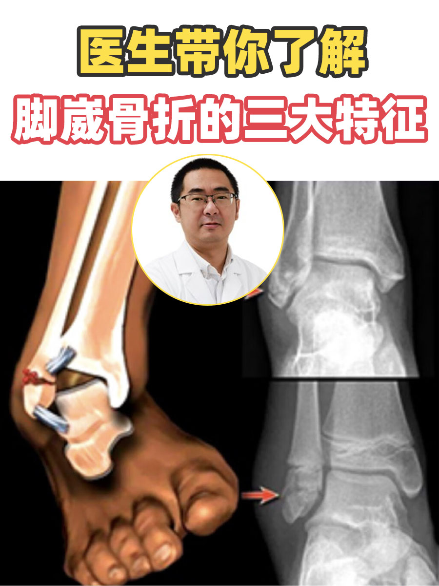 医生带你了解,脚崴骨折的三大特征 脚踝是人体最常发生骨折的部位之一