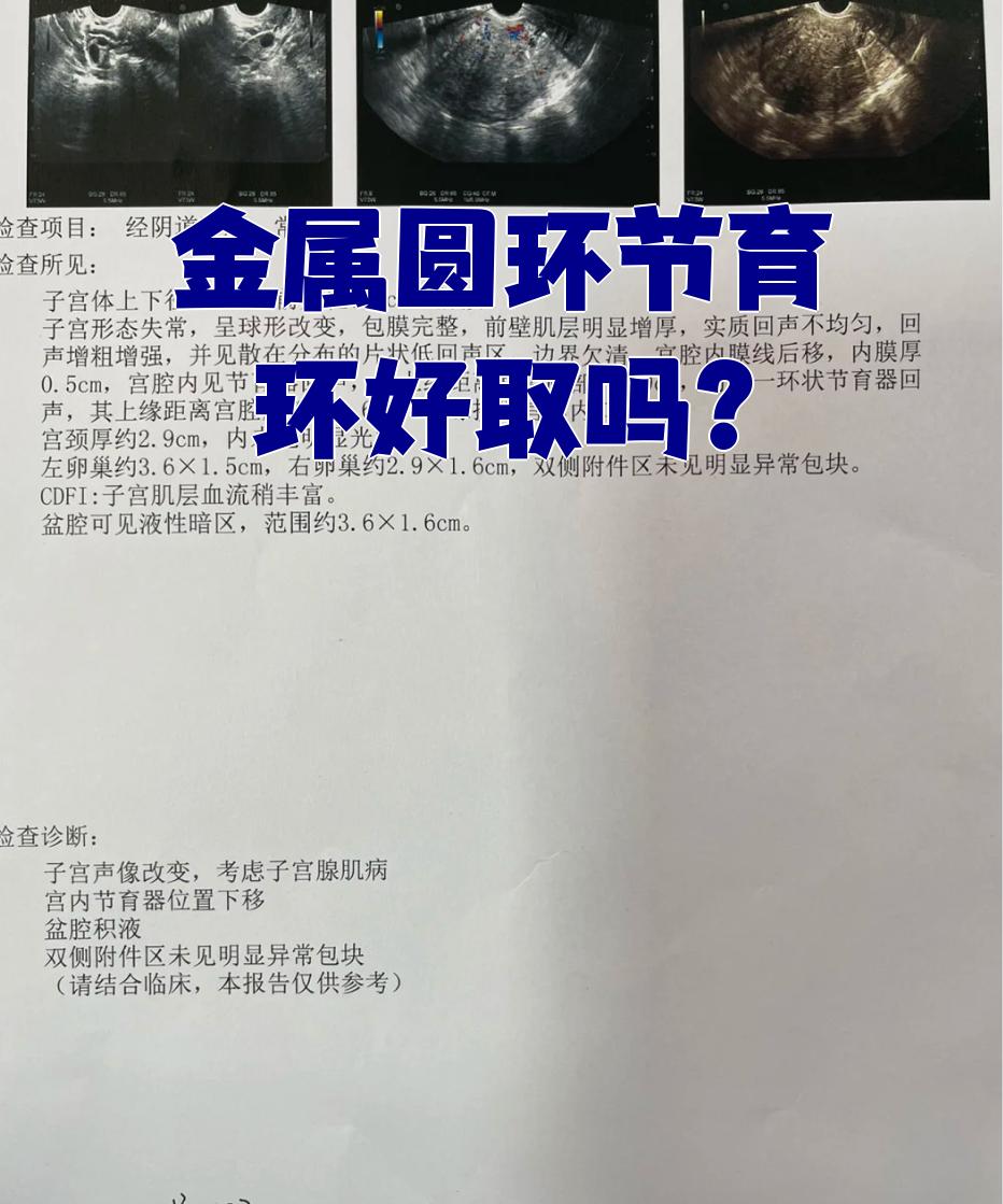 金属圆环节育环一般比较好取,尤其是未绝经的女性,或者没有出现节 