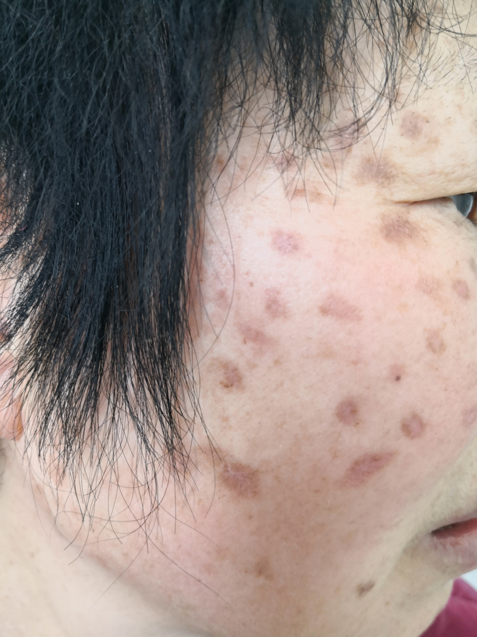 自行使用醋酸涂擦面部治疗色斑后,炎症后色素沉着过度症状明显.