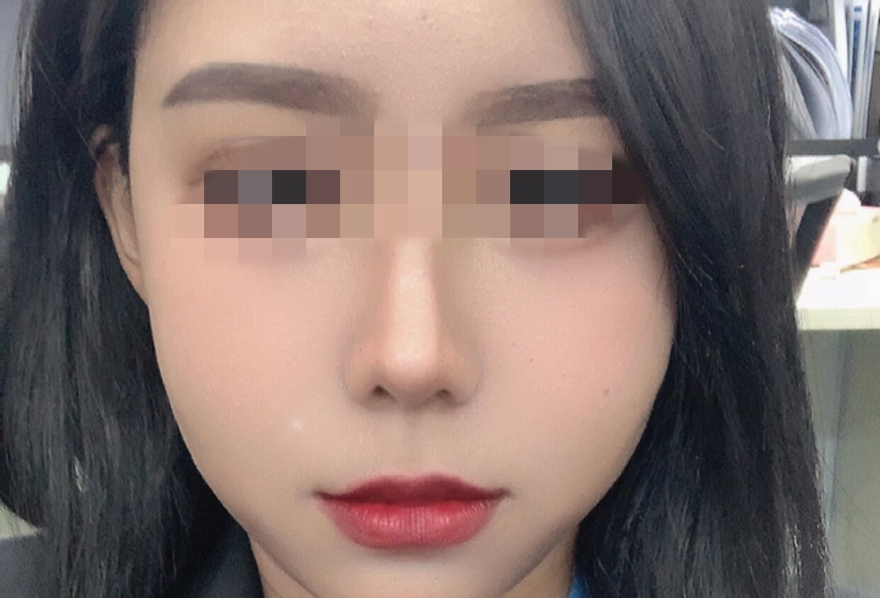 看看对比10斤加激素满月脸的对比